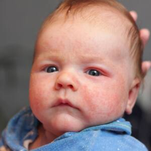 Atopowe zapalenie skóry u niemowlaka 2 wieku 6-12 miesięcy