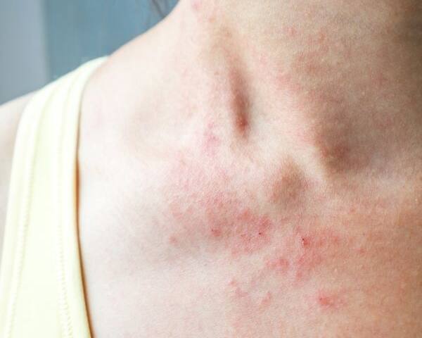 Atopowe Zapalenie Skóry (AZS) to przewlekła choroba skóry o skomplikowanej etiologii