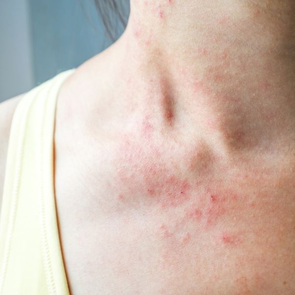 Atopowe Zapalenie Skóry (AZS) to przewlekła choroba skóry o skomplikowanej etiologii